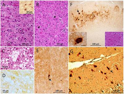 Case Report: Histopathology and Prion Protein Molecular Properties in Inherited Prion Disease With a De Novo Seven-Octapeptide Repeat Insertion